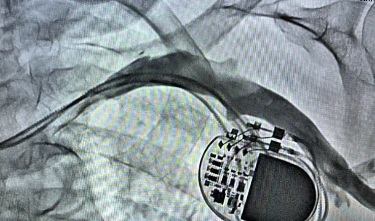 Pacemaker implantation