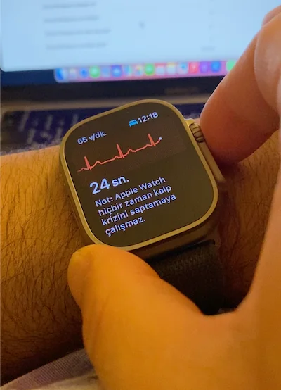 ECG recording with a smartwatch