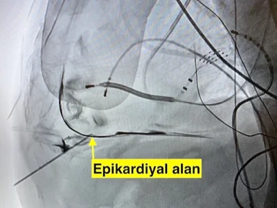 Needle access to the epicardial area during epicardial ablation