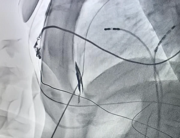 Epicardial ablation