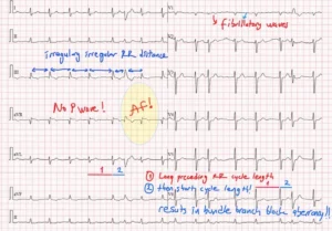 Atrial Fibrillation ECG Drawing