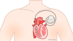 Cardiac Pacemakers
