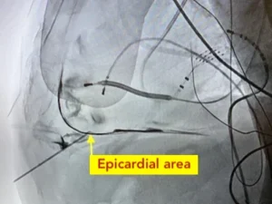 Epicardial Ablation