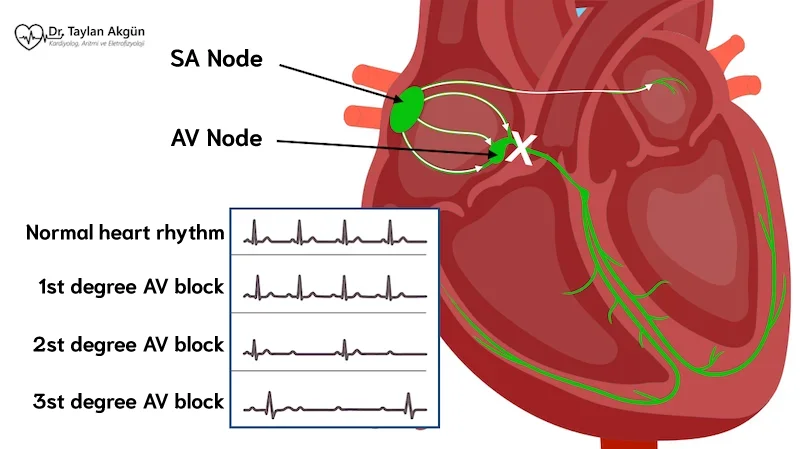 First Degree Av Block First Degree Av Block