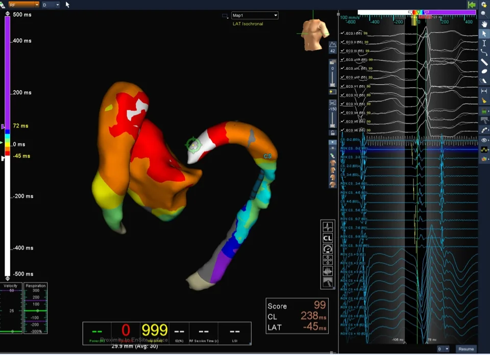 3D ablation of PVCs
