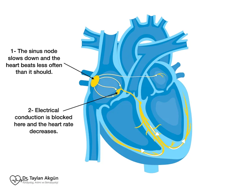 Bradycardia (low heart rate)