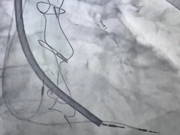 Pacemaker lead extraction