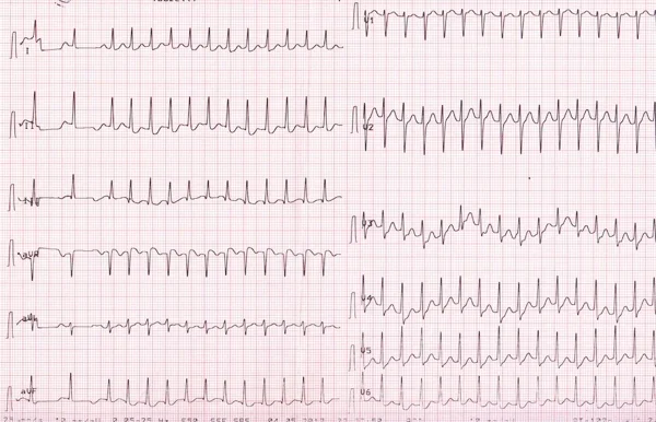 What is Supraventricular Tachycardia