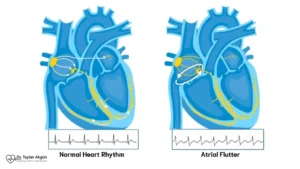 Atrial Flutter