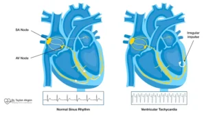 Ventricular Tachycardia