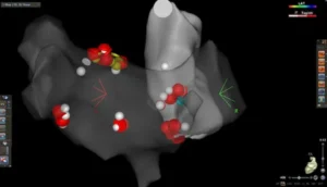 cardioneuroablation