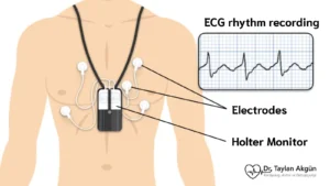 Example image showing how a Holter monitor is worn and used in daily life