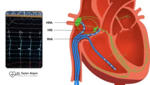 Electrophysiology Study (EP)