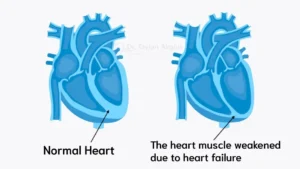 The heart muscle weakened due to heart failure
