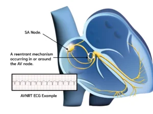 AVNRT Mechanism and ECG Example