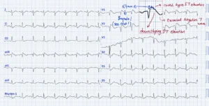 Brugada Syndrome ECG Example