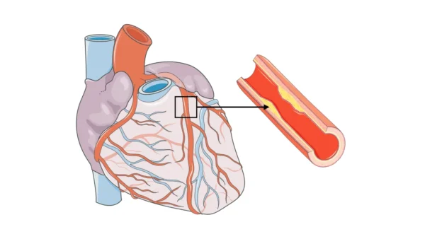 Coronary artery disease (CAD)