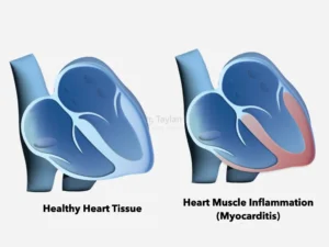 Heart Muscle Inflammation (Myocarditis)
