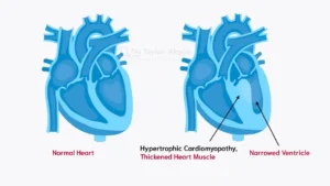 Hypertrophic Cardiomyopathy, Thickened Heart Muscle