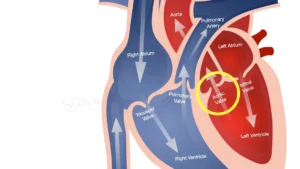 Aortic Valve Disease