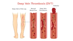 Deep Vein Thrombosis