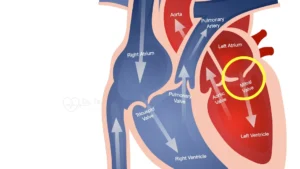 Mitral Valve Disease