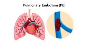 Pulmonary Embolism