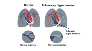 Pulmonary Hypertension