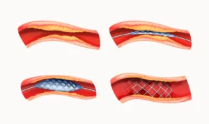 Balloon Angioplasty and Stent