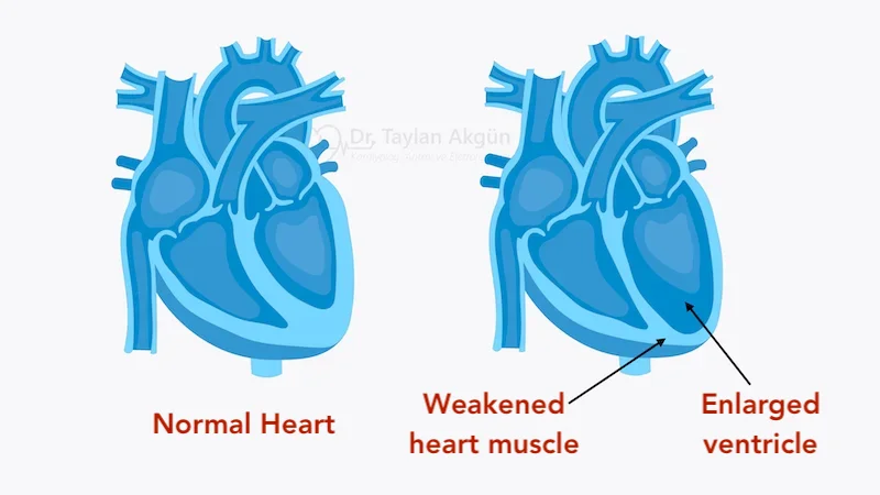 Dilated Cardiomyopathy