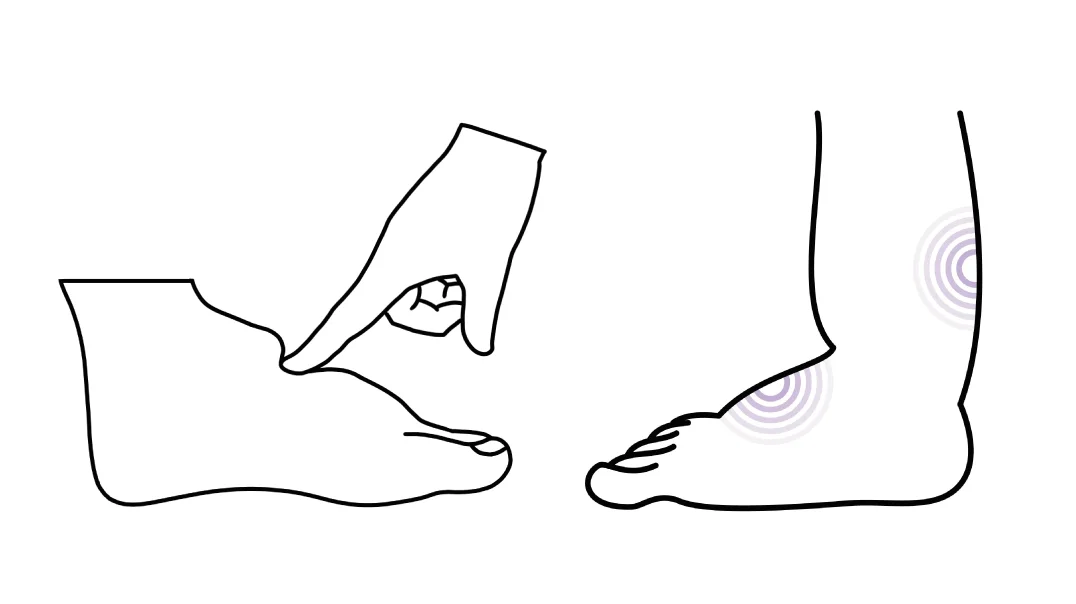 Edema