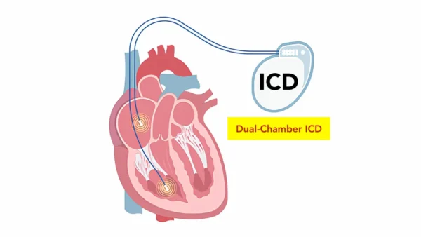 Implantable cardioverter defibrillator (ICD)