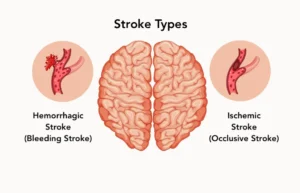 Stroke (ischemic and hemorrhagic stroke)
