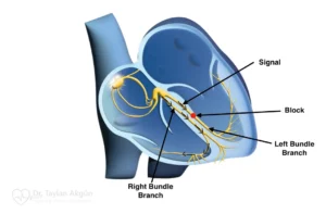 Left bundle branch block (LBBB)