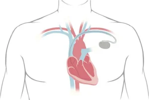 Living with a pacemaker: what to pay attention to after implantation
