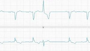 Premature Ventricular Contraction (PVC) Ablation