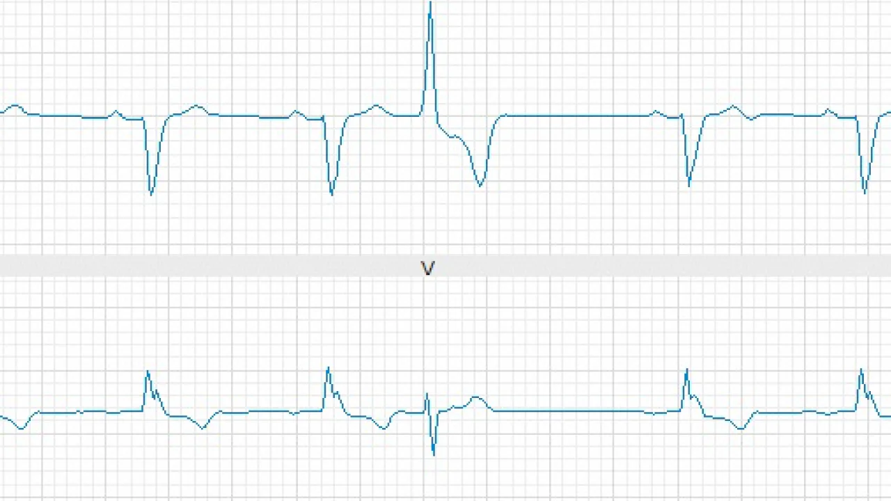 Premature Ventricular Contraction (PVC) Ablation
