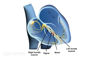Right bundle branch block (RBBB)