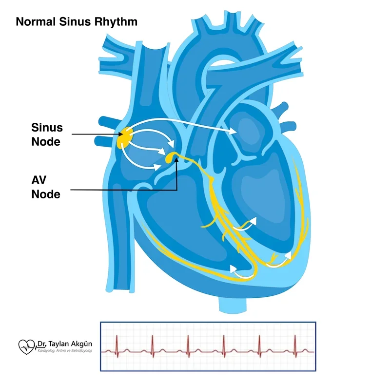 Heart Attack and Arrhythmias: The Connection