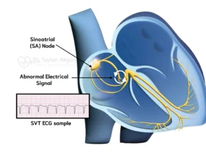 Supraventricular Tachycardia (SVT) Ablation