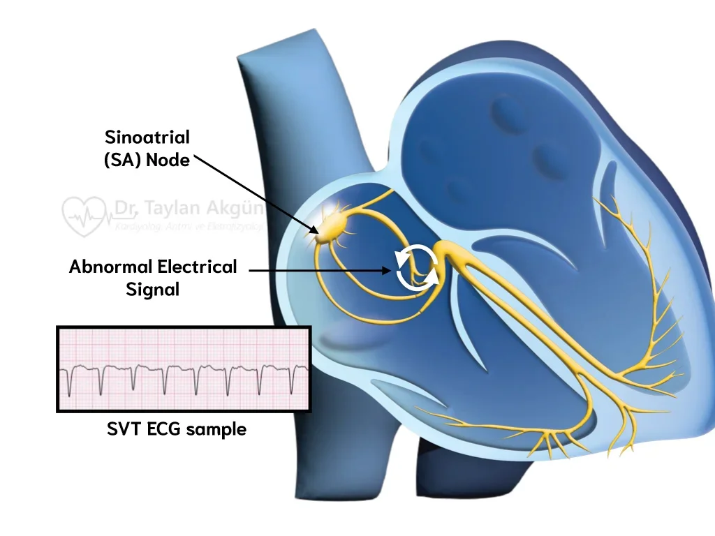 Supraventricular Tachycardia (SVT) Ablation