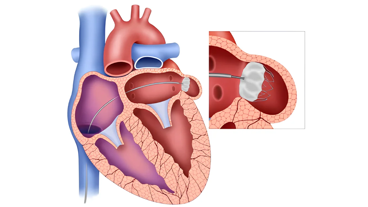 Left Atrial Appendage Closure